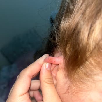 Aldığım Saç Boyası Ciddi Alerjik Reaksiyona Sebep Oldu