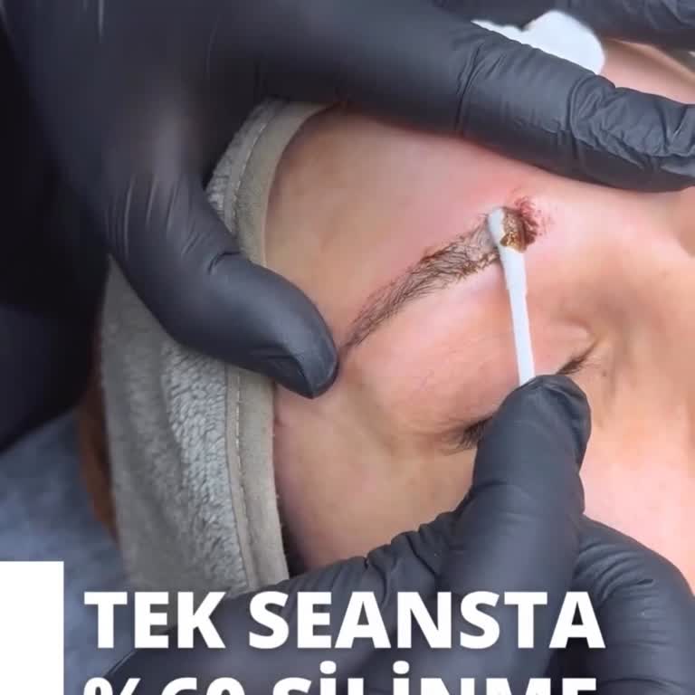 Aris Güzellik Merkezleri Kaş Silme İşleminde Vaat Edilen Sonuç Gerçekleşmedi