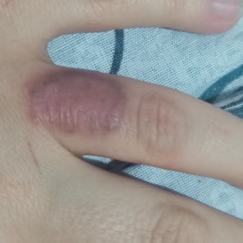 Dövme Silme İşlemi Sonrası Kalıcı Yanık İzleri Oluştu