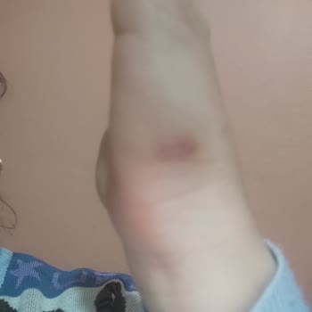 Dövme Silme İşlemi Sonrası Kalıcı Yanık İzleri Oluştu