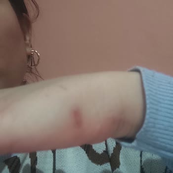 Dövme Silme İşlemi Sonrası Kalıcı Yanık İzleri Oluştu