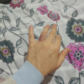 Dövme Silme İşlemi Sonrası Kalıcı Yanık İzleri Oluştu