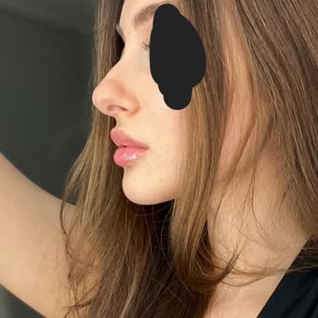 İstediğim Doğal Burun Yerine Travmatik Sonuçlar Ve İş Kaybı Yaşadım