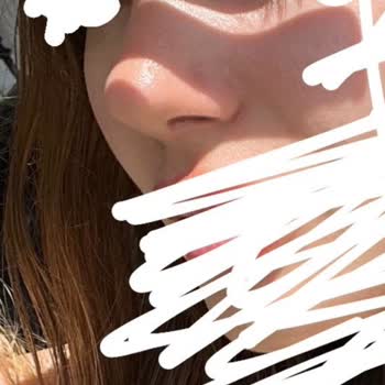 İstediğim Doğal Burun Yerine Travmatik Sonuçlar Ve İş Kaybı Yaşadım