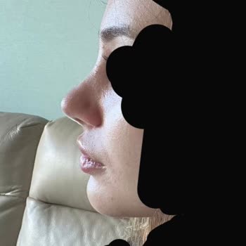 İstediğim Doğal Burun Yerine Travmatik Sonuçlar Ve İş Kaybı Yaşadım