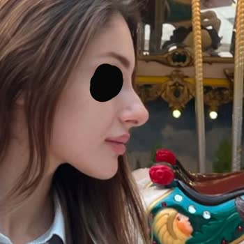 İstediğim Doğal Burun Yerine Travmatik Sonuçlar Ve İş Kaybı Yaşadım