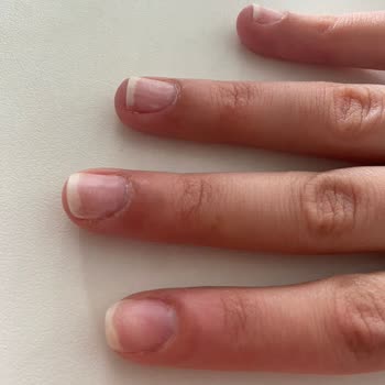 Tırnak Çıkarma İşlemi Sonrası Hasar Ve Ekstra Ücret Sorunu