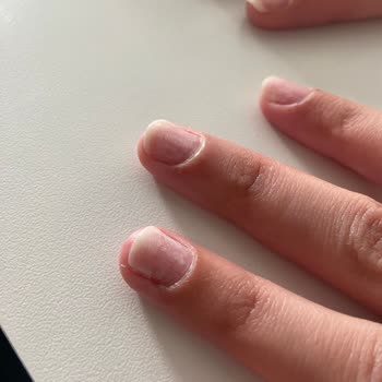 Tırnak Çıkarma İşlemi Sonrası Hasar Ve Ekstra Ücret Sorunu