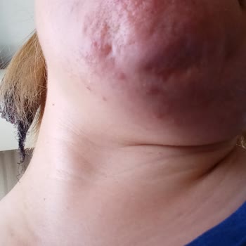 Btxcream.tr Botoks Etkili Krem Cildimde Yanma ve Sivilce Yaptı