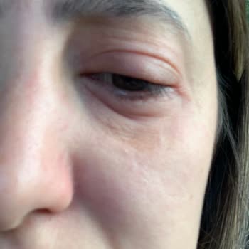 Lancome Renergie Yeux Caused Irritation and Swelling Around My Eyes