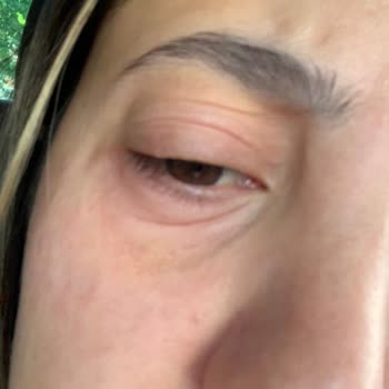 Lancome Renergie Yeux Caused Irritation and Swelling Around My Eyes