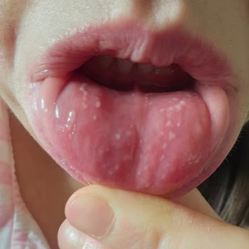 Sensodyne Toothpaste Caused Mouth Sores and May Be Affecting Internal Health