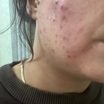 Cilt Bakımı Sonrası Yüzümde Oluşan Sorunlar Ve İlgisizlik