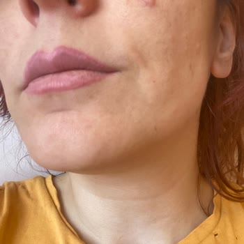 PH Lab Ürünleri Cildimde Kuruluk Ve Sivilceye Yol Açtı