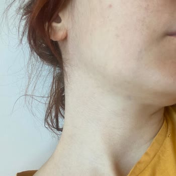 PH Lab Ürünleri Cildimde Kuruluk Ve Sivilceye Yol Açtı