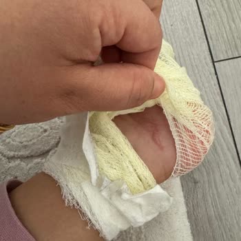 Stanley Eksik Parça Nedeniyle Ciddi Yanık Ve Mağduriyet