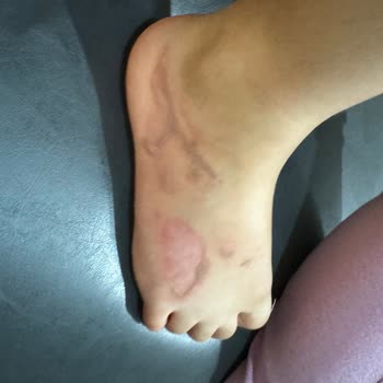 Stanley Eksik Parça Nedeniyle Ciddi Yanık Ve Mağduriyet