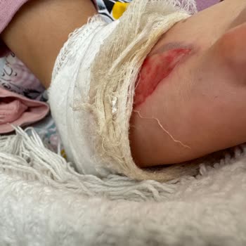 Stanley Eksik Parça Nedeniyle Ciddi Yanık Ve Mağduriyet