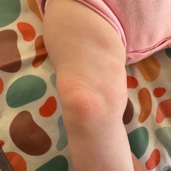 Mustela Shampoo and Lotion Worsened My Baby’s Eczema Instead of Helping