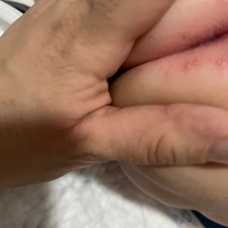 Mustela Skincare Caused White Bumps on My Baby’s Skin