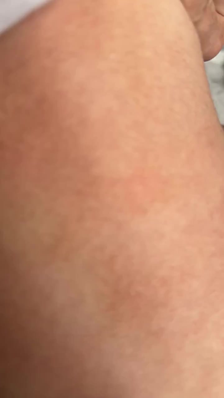 Mustela Shampoo Triggered Eczema on My Baby’s Back and Arms After Every Bath video cover