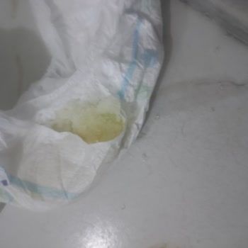 Külot Bezlerde Erken Dağılma Ve Sızdırma Sorunu