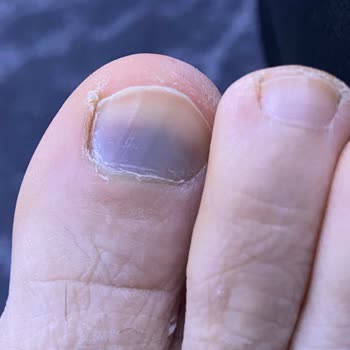 Yeni Alınan Ayakkabı Ayağımı Morarttı, İade Talebim Reddedildi