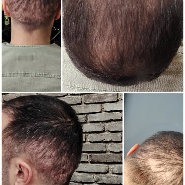 Saç Ekimi Sonrası İletişim Sorunu Ve Olumsuz Sonuçlar