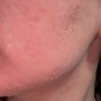 La Roche - Posay Hassas Ciltte Şiddetli Reaksiyon ve Yoğun Koku