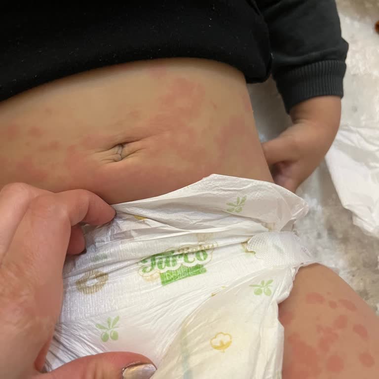 Baby Turco Bebek Bezinde Alerji Sorunu Yaşadık