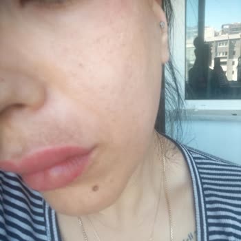 Medical Clinic Güzellik Hizmetleri Lazerin Atış İzleri Kaldı