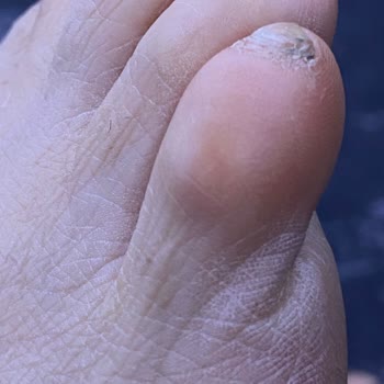 My Adidas Runfalcon 5 Shoes Caused Severe Foot Pain and Bruising