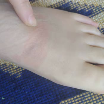 Nike Ayakkabıda Kronik Baskı Ve Uyuşma Sorunu, İnceleme Talebi