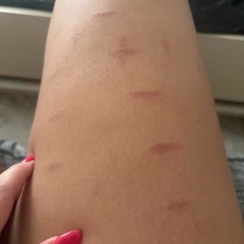 Aldığım Lazer Epilasyon Cihazı Cildimde Yanıklara Sebep Oldu