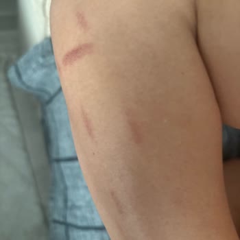 Aldığım Lazer Epilasyon Cihazı Cildimde Yanıklara Sebep Oldu