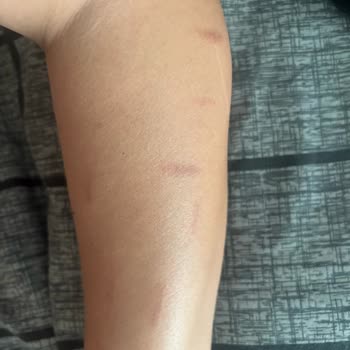 Aldığım Lazer Epilasyon Cihazı Cildimde Yanıklara Sebep Oldu