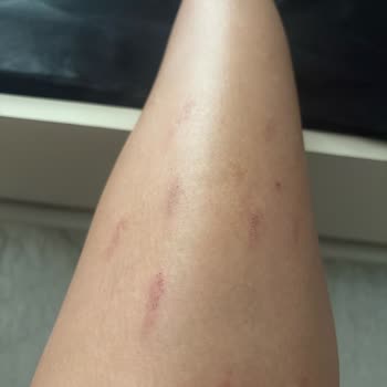 Aldığım Lazer Epilasyon Cihazı Cildimde Yanıklara Sebep Oldu