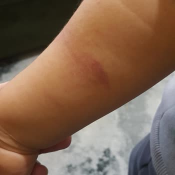 Çocuğuma Kan Alımı Sırasında Yaşanan Olumsuz Deneyim Ve İlgisiz Yaklaşım