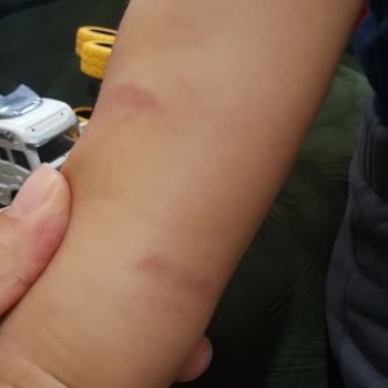 Çocuğuma Kan Alımı Sırasında Yaşanan Olumsuz Deneyim Ve İlgisiz Yaklaşım