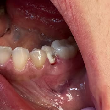 Ekinova Fırın'dan Aldığım Kraker Dişimi Kırdı