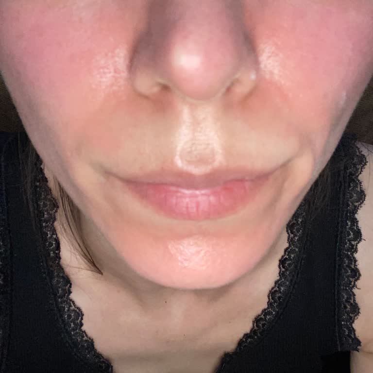 Ciltte Kızarıklık Ve Kabarmaya Yol Açan Krem Deneyimi