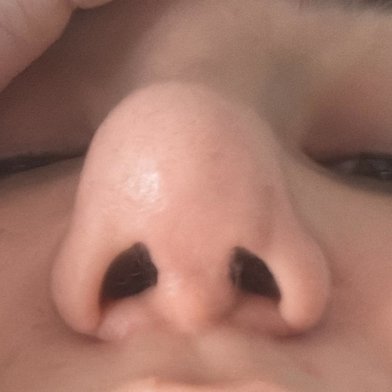 Op. Dr. Alpaslan Yıldırım Burun Estetiği Sonrası Bitmeyen Sorunlar ve Hayal Kırıklığı