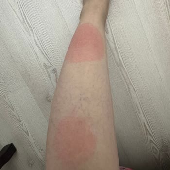 Uçuş Sırasında Halıdan Kaynaklı Yanık Ve Yaralanma