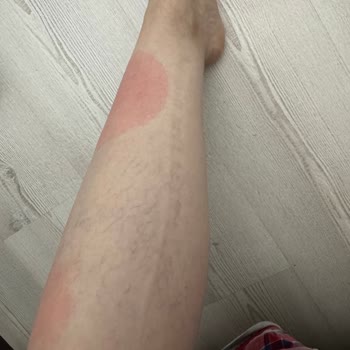 Uçuş Sırasında Halıdan Kaynaklı Yanık Ve Yaralanma