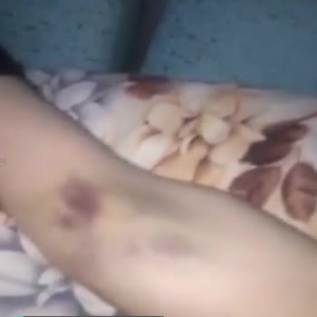 Karabük Eğitim Araştırma Hastanesi Personel Şikayeti, Kolda Yanlış Damar Yolu