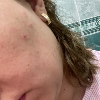 The Purest Renkli Güneş Kremi Cildimde Sivilce Yaptı, Beklentimi Karşılamadı