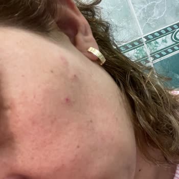 The Purest Renkli Güneş Kremi Cildimde Sivilce Yaptı, Beklentimi Karşılamadı