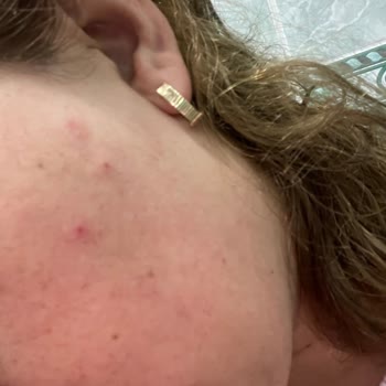 The Purest Renkli Güneş Kremi Cildimde Sivilce Yaptı, Beklentimi Karşılamadı