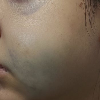 Steril Olmayan Ortam Ve Doktor İhmalinden Kaynaklanan Ciddi Sağlık Sorunu