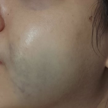 Steril Olmayan Ortam Ve Doktor İhmalinden Kaynaklanan Ciddi Sağlık Sorunu